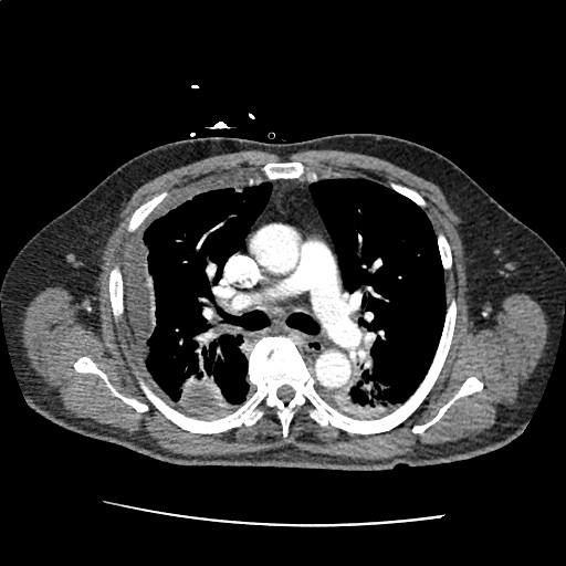 Pleural Effusion Tags Differential Diagnosis of